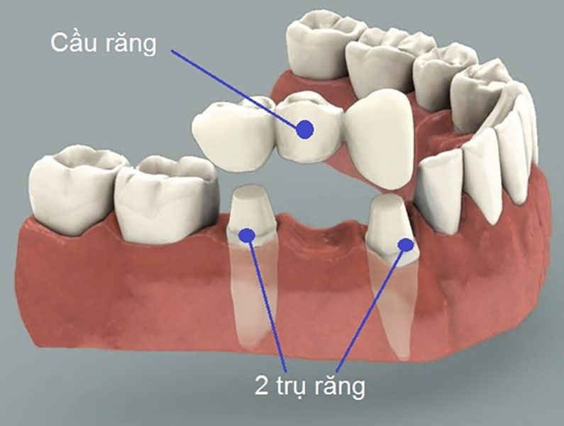 Giải pháp phục hồi cho trường hợp mất răng
